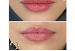 تزریق ژل و بوتاکس